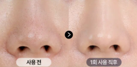 ชุดมาส์กหน้า Medi Peel Extra Super 9 Plus สำหรับกำจัดสิวหัวดำบริเวณจมูก 1 ชุด